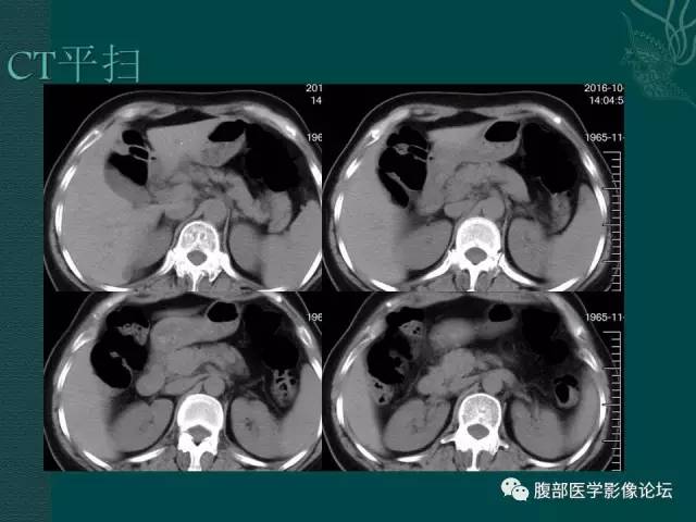 【病例】腹膜后副神经节瘤1例CT影像表现 【病例】腹膜后副神经节瘤1例CT影像表现