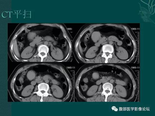 【病例】腹膜后副神经节瘤1例CT影像表现 【病例】腹膜后副神经节瘤1例CT影像表现