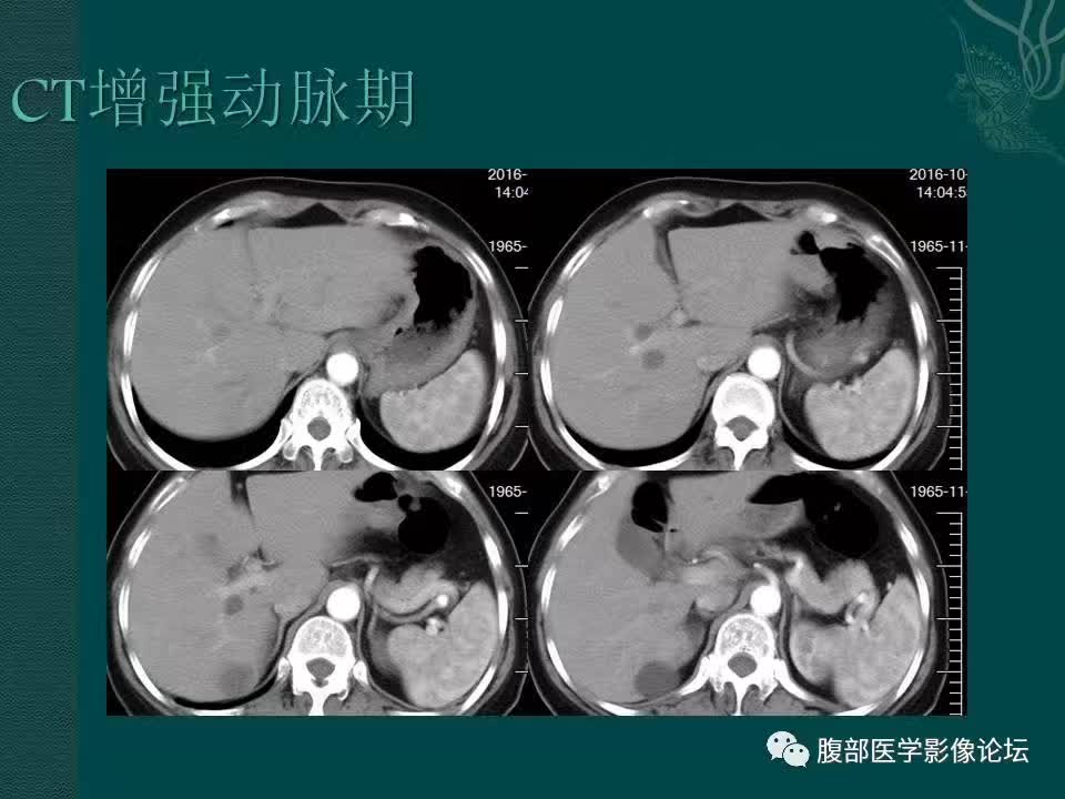 【病例】腹膜后副神经节瘤1例CT影像表现 【病例】腹膜后副神经节瘤1例CT影像表现