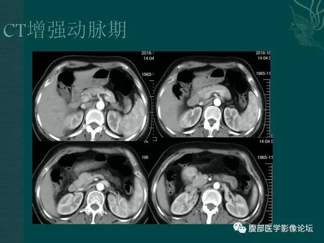【病例】腹膜后副神经节瘤1例CT影像表现 【病例】腹膜后副神经节瘤1例CT影像表现