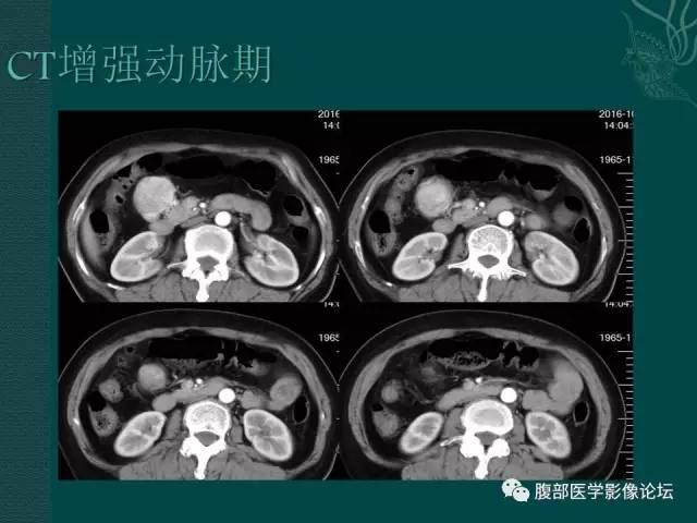 【病例】腹膜后副神经节瘤1例CT影像表现 【病例】腹膜后副神经节瘤1例CT影像表现