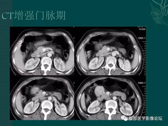 【病例】腹膜后副神经节瘤1例CT影像表现 【病例】腹膜后副神经节瘤1例CT影像表现