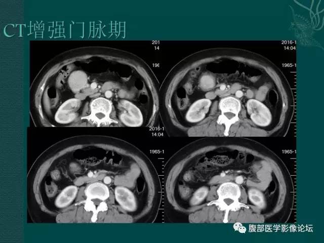 【病例】腹膜后副神经节瘤1例CT影像表现 【病例】腹膜后副神经节瘤1例CT影像表现