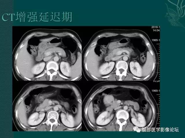 【病例】腹膜后副神经节瘤1例CT影像表现 【病例】腹膜后副神经节瘤1例CT影像表现