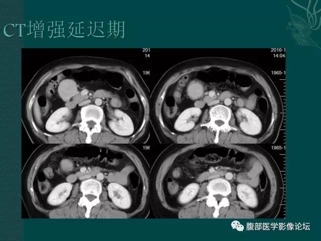 【病例】腹膜后副神经节瘤1例CT影像表现 【病例】腹膜后副神经节瘤1例CT影像表现