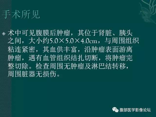 【病例】腹膜后副神经节瘤1例CT影像表现 【病例】腹膜后副神经节瘤1例CT影像表现