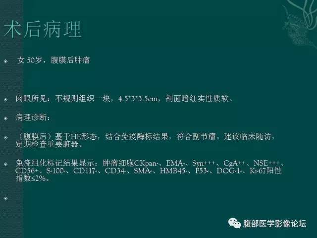 【病例】腹膜后副神经节瘤1例CT影像表现 【病例】腹膜后副神经节瘤1例CT影像表现
