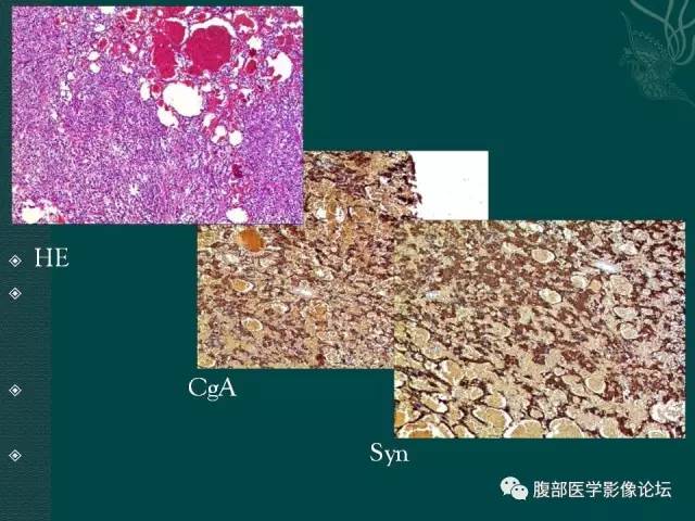 【病例】腹膜后副神经节瘤1例CT影像表现 【病例】腹膜后副神经节瘤1例CT影像表现