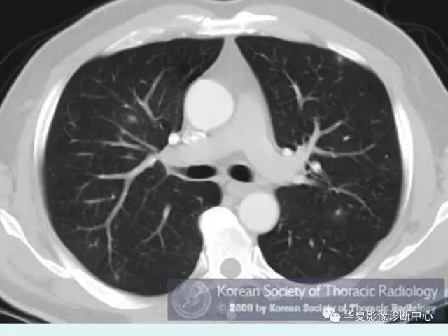 【病例】水痘性肺炎1例CT影像表现