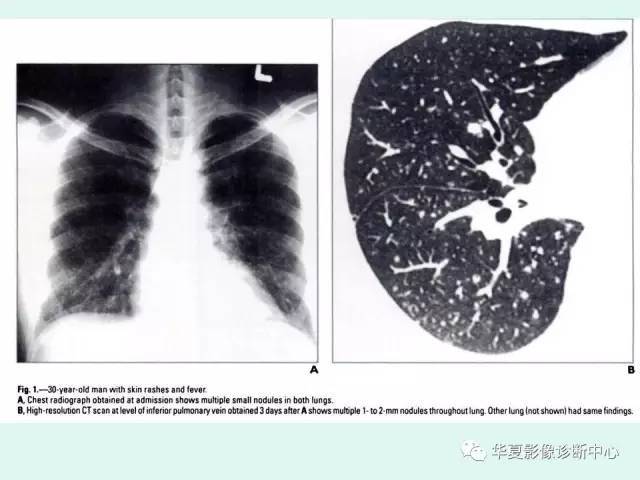 【病例】水痘性肺炎1例CT影像表现