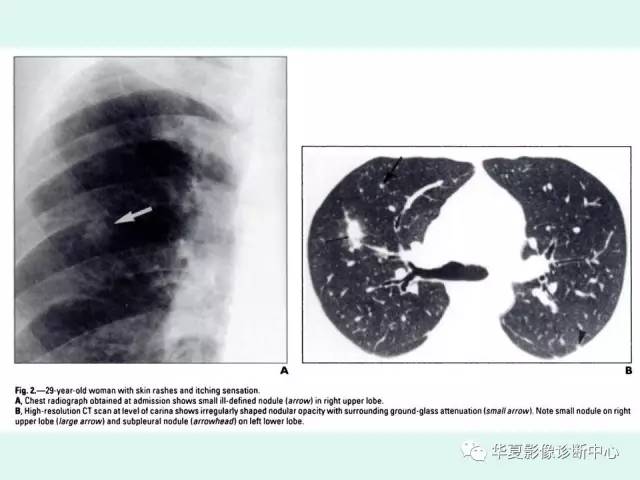 【病例】水痘性肺炎1例CT影像表现