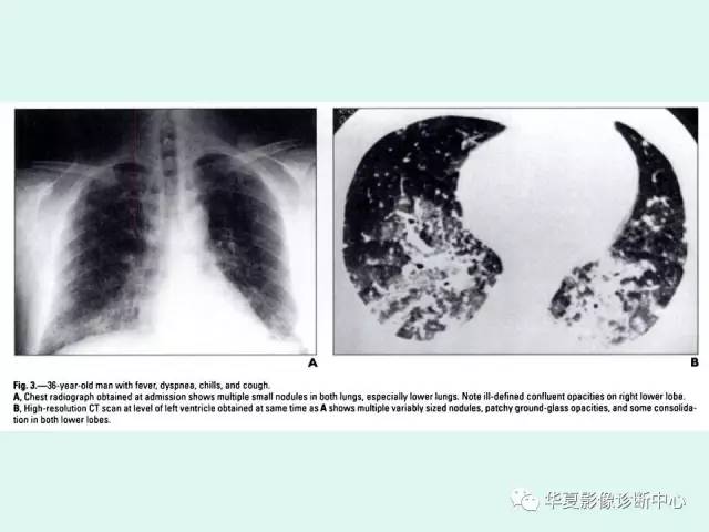 【病例】水痘性肺炎1例CT影像表现