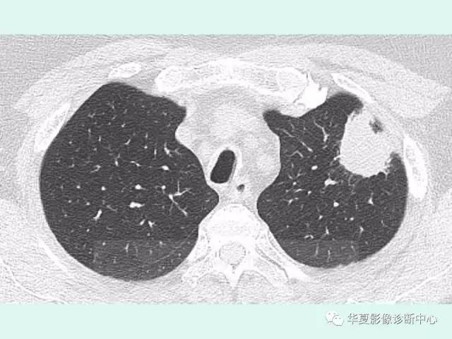 【病例】肉芽肿性血管炎1例CT影像表现