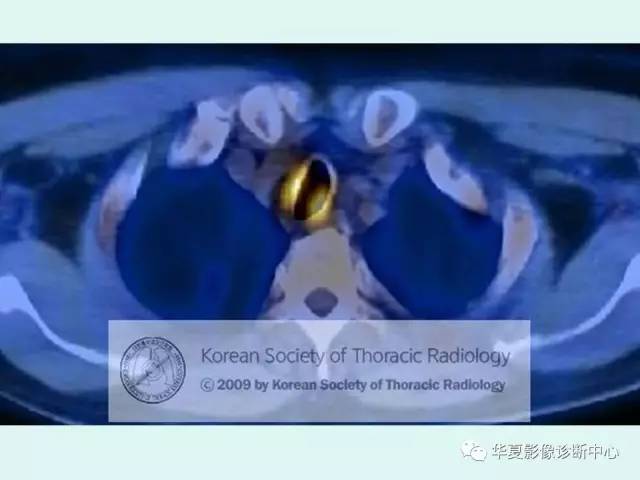 【病例】肉芽肿性血管炎1例CT影像表现