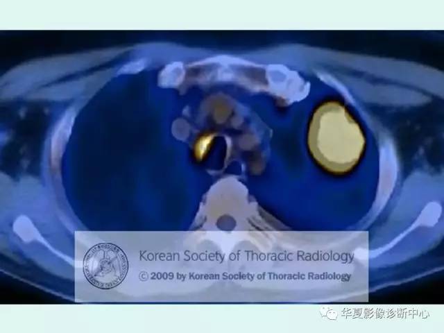 【病例】肉芽肿性血管炎1例CT影像表现