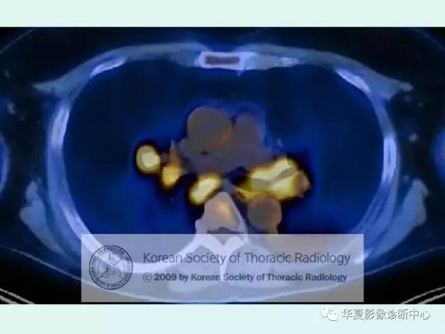 【病例】肉芽肿性血管炎1例CT影像表现