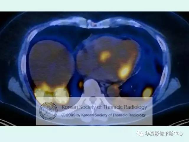 【病例】肉芽肿性血管炎1例CT影像表现