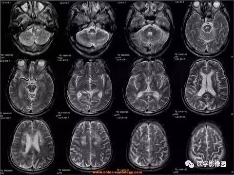 【病例】脑桥中央髓鞘溶解症1例MR影像表现