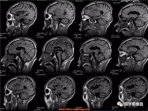 【病例】脑桥中央髓鞘溶解症1例MR影像表现 【病例】脑桥中央髓鞘溶解症1例MR影像表现