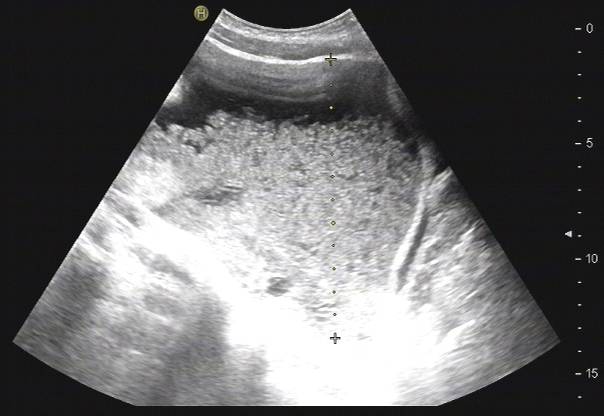 【病例】腹膜假性黏液瘤1例CT影像表现 【病例】腹膜假性黏液瘤1例CT影像表现