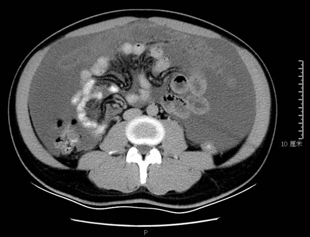 【病例】腹膜假性黏液瘤1例CT影像表现 【病例】腹膜假性黏液瘤1例CT影像表现