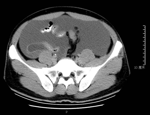 【病例】腹膜假性黏液瘤1例CT影像表现 【病例】腹膜假性黏液瘤1例CT影像表现