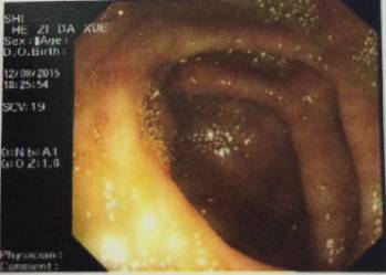 【病例】腹膜假性黏液瘤1例CT影像表现 【病例】腹膜假性黏液瘤1例CT影像表现