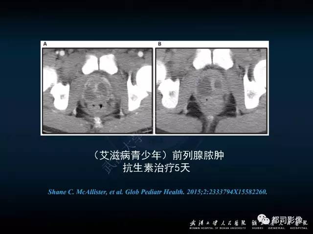 【PPT】前列腺脓肿的临床与影像