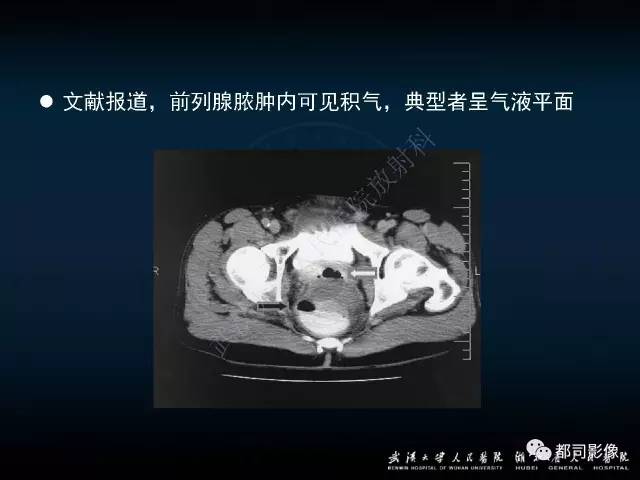 【PPT】前列腺脓肿的临床与影像