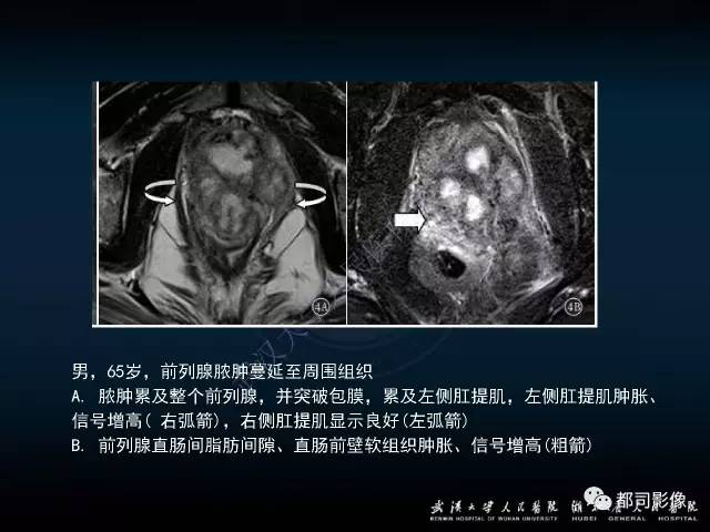 【PPT】前列腺脓肿的临床与影像