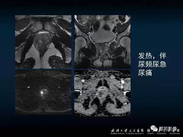 【PPT】前列腺脓肿的临床与影像