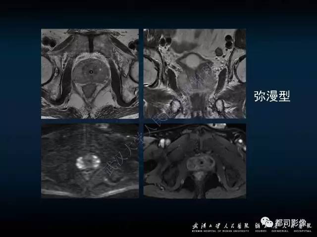 【PPT】前列腺脓肿的临床与影像