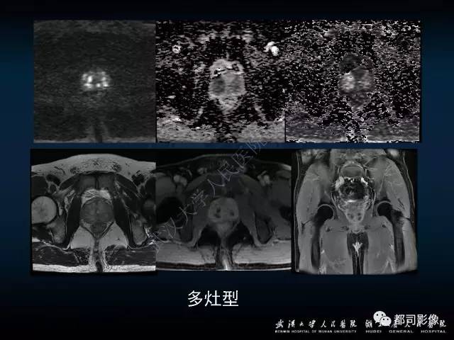 【PPT】前列腺脓肿的临床与影像