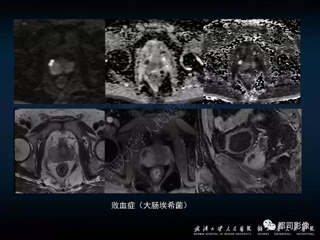 【PPT】前列腺脓肿的临床与影像