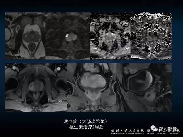 【PPT】前列腺脓肿的临床与影像