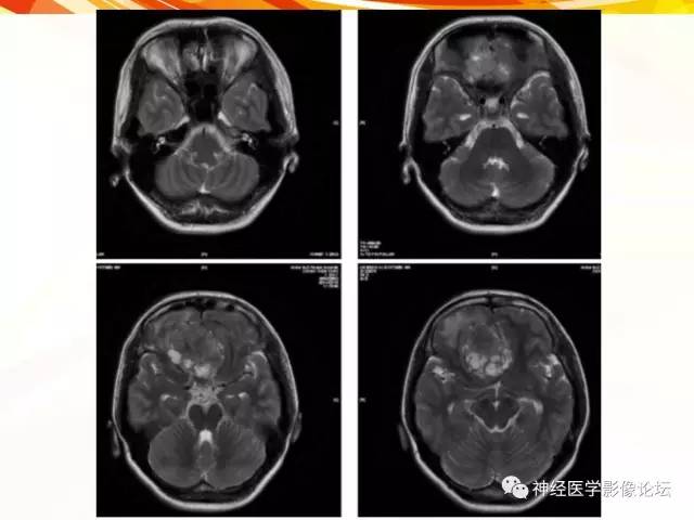 【病例】血管外皮细胞瘤1例MR影像讨论