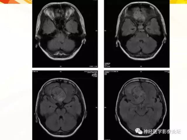 【病例】血管外皮细胞瘤1例MR影像讨论