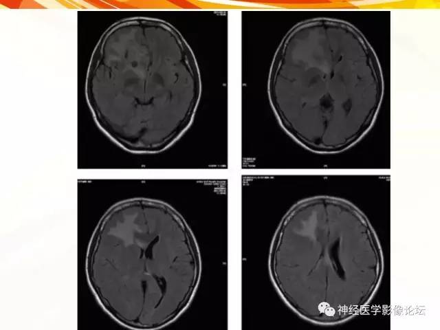 【病例】血管外皮细胞瘤1例MR影像讨论