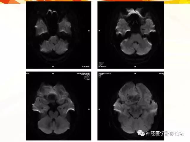 【病例】血管外皮细胞瘤1例MR影像讨论