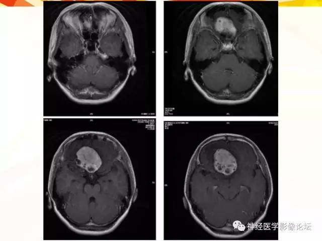 【病例】血管外皮细胞瘤1例MR影像讨论