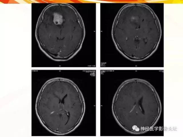 【病例】血管外皮细胞瘤1例MR影像讨论
