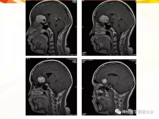 【病例】血管外皮细胞瘤1例MR影像讨论