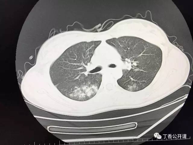 【病例】百草枯中毒肺部影像表现