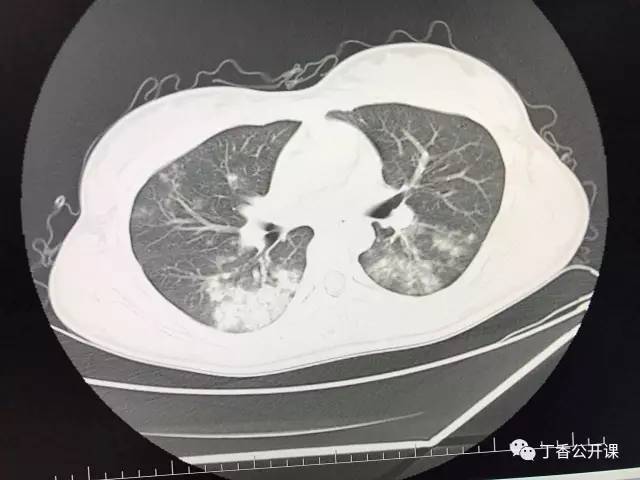 【病例】百草枯中毒肺部影像表现