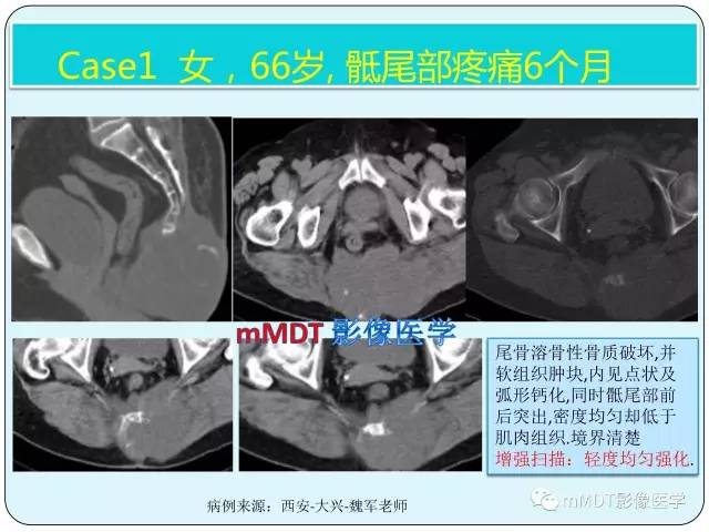 【PPT】骶尾骨脊索瘤的影像诊断