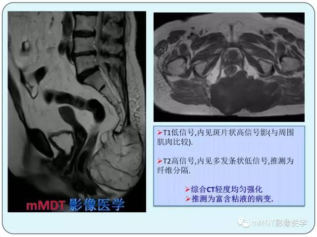 【PPT】骶尾骨脊索瘤的影像诊断