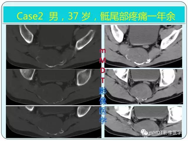 【PPT】骶尾骨脊索瘤的影像诊断