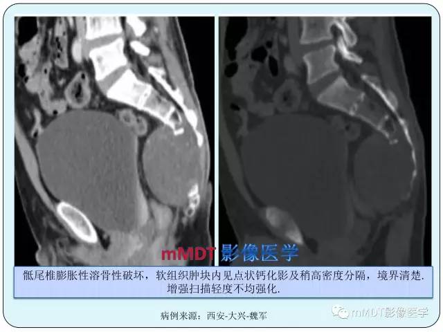 【PPT】骶尾骨脊索瘤的影像诊断