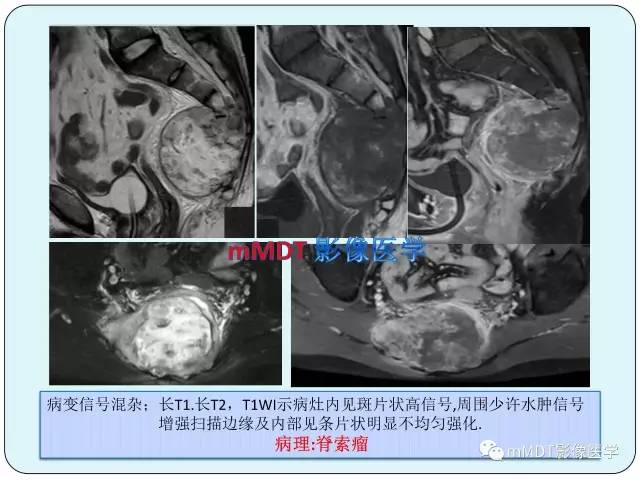 【PPT】骶尾骨脊索瘤的影像诊断