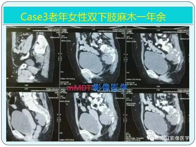 【PPT】骶尾骨脊索瘤的影像诊断